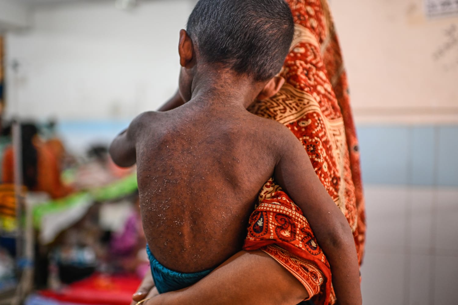 Bangladesh Races to Control Growing Measles-worldfrontng.com